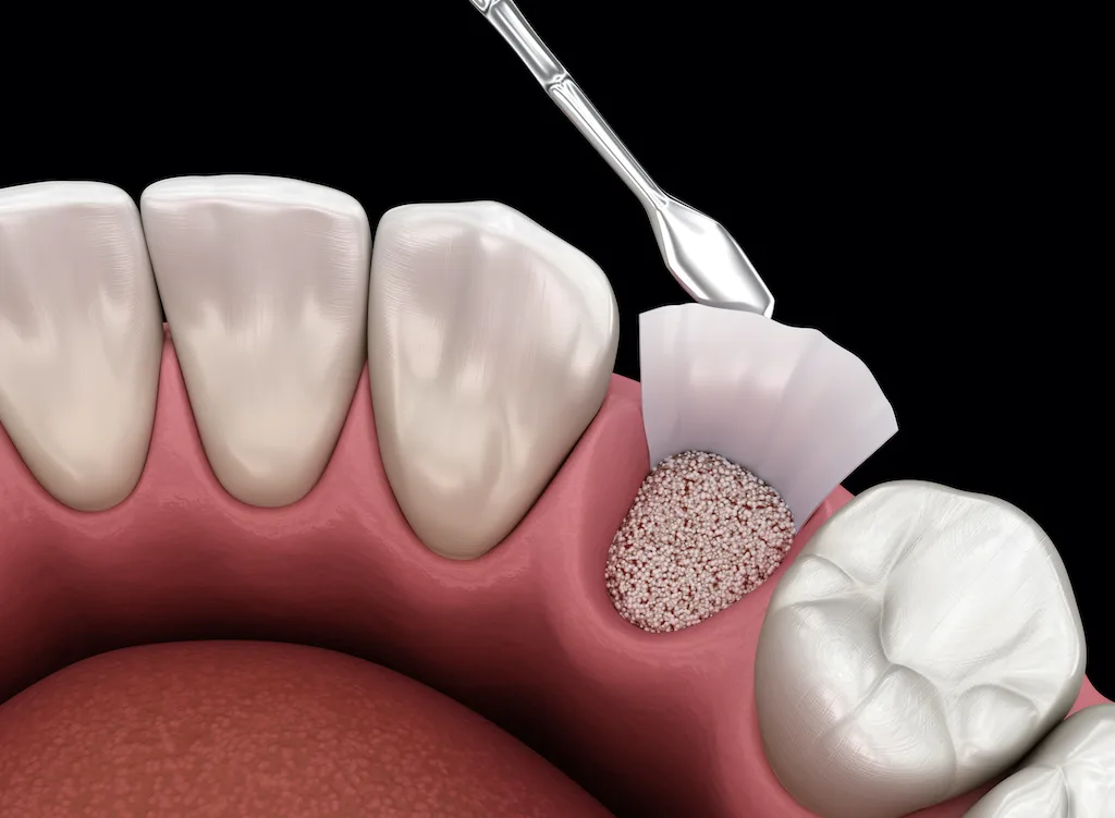 Augmentation Surgery - Adding bone after tooth extraction. 3D illustration - Dentaluxe
