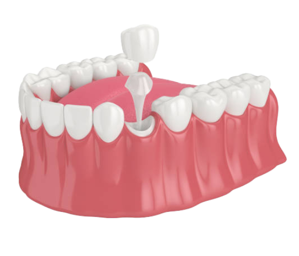 image of a single dental implant hybrid - dentaluxe