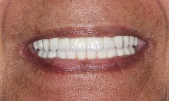 Close up of Jose's dental implants - Dentaluxe
