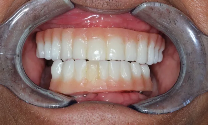Before dental implants are fitted - Dentaluxe