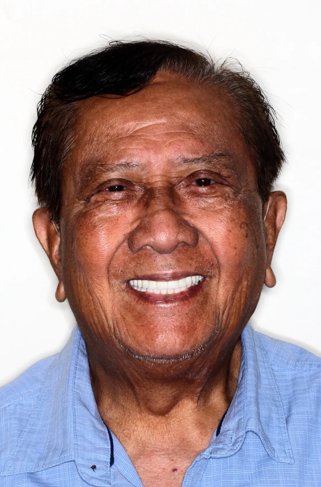 Jose Dagdayan with new dental implants - Dentaluxe