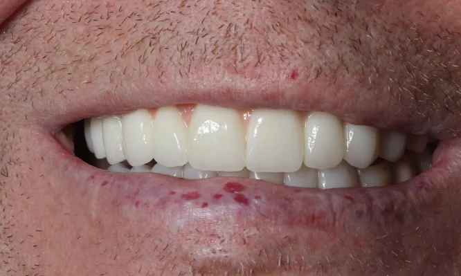 closeup of Vadim's teeth implants - Dentaluxe