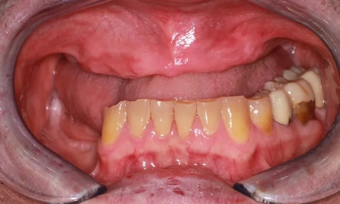 Before shot of Vadim's moth before implants - Dentaluxe