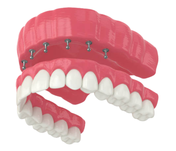 image depicting how implant dentures snap in - dentaluxe