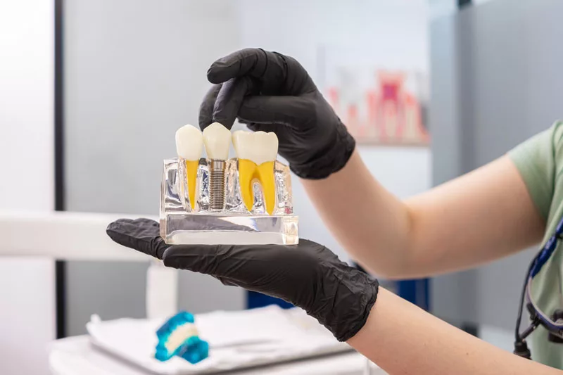 Dentist holding a dental implant in his hands, the dental implant model is oversized to see the details.
