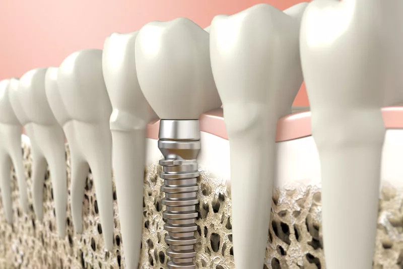 dental implants model