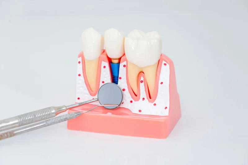 Dental implant, artificial tooth roots into jaw, root canal of dental treatment, gum disease, teeth model for dentist studying about dentistry