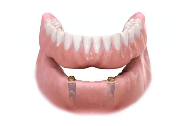 Lower Over dentures Example Model