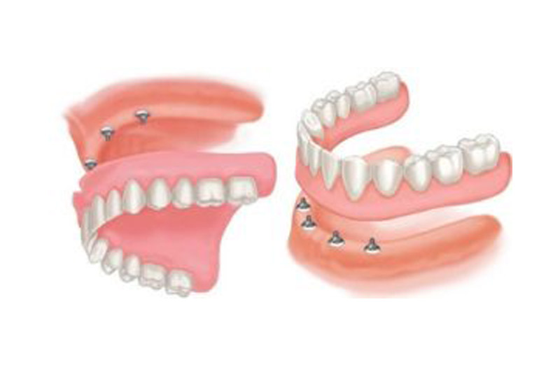 Over dentures Example Model