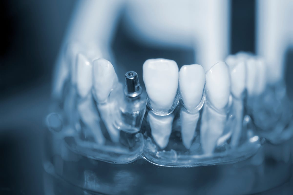 Close up image of a dentist carefully attaching an abutment to a dental implant in a patient's mouth, using specialized tools. The focus is on the precision and detail of the procedure, with the dentist wearing gloves and a mask. No text on image.